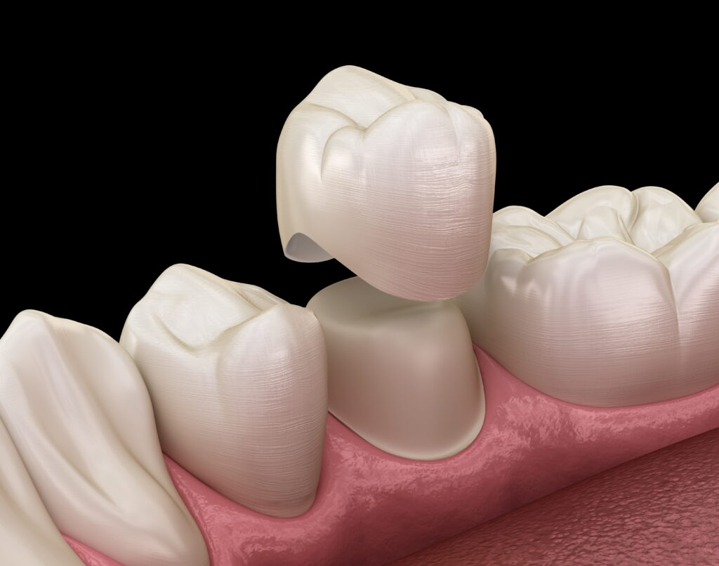 A Dental Crown Can Beautifully Restore Your Tooth